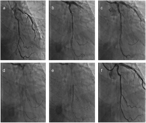Figure 3. A PCI procedure was performed on a 67-year-old male patient with a bifurcation lesion in the mid-segment of the left circumflex artery. (a) The CAG displayed that was a true bifurcation of the LCX/OM. (b) The stent (3.5 mm × 20 mm) was withdrawn to an appropriate position that cover the MV lesion, and the mid-segment of the jailed balloon (1.5 mm × 16 mm) was adjusted to be located at the ridge of the lesion. (c) The MV stent was inflated at 8 atm and the jailed balloon was inflated at 11 atm. (d) The MV stent balloon was deflated. (e) The MV stent balloon was re-inflated to make the stent appose the vessel wall. (f) The diameter stenosis of the side branch had a significant improvement.