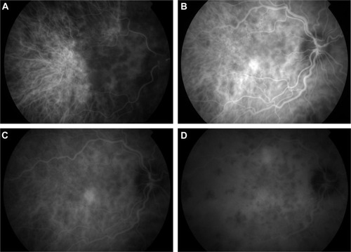 Figure 10 ICG photographs of the right eye of a patient in the acute phase of VKHD showing (A) patchy hypofluorescence during the early angiographic phase, (B) large choroidal stromal vessel hyperfluorescence with fuzzy choroidal vessels in the early phase, (C) hypofluorescent dark dots during the intermediate phase of angiography, and (D) diffuse choroidal hyperfluorescence in the late phase.