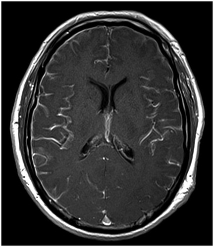 Figure 1. Representative MRI of the brain in a patient with leptomeningeal ATTRY69H (p.ATTRY89H) amyloidosis showing abnormally increased leptomeningeal enhancement. Axial, gadolinium-enhancend T1-weighted sequence (TE/TR 17/580 ms; slice thickness 6 mm); 1.5 Tesla MR scanner (Magnetom Avanto, Siemens AG, Germany). A similar distribution pattern was also described in an ATTRY69H patient by Blevins et al. [Citation5].