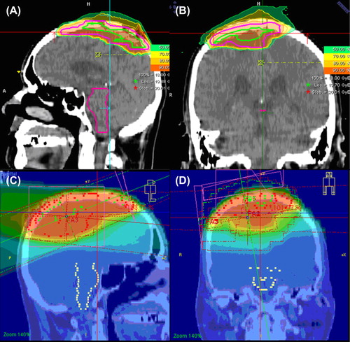 Figure 2. Boost treatment of high-risk meningiomas (A, B) with carbon ions in 6 fractions to a total dose of 18 GyE (MARCIE-Protocol), and photon treatment (C, D) up to 50 GyE in 2 GyE single fractions.