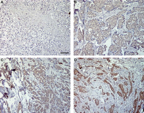 Figure 1. Ghrelin expression in invasive breast cancer tissue was analyzed by immunohistochemistry. Representative images of ghrelin with A (non-immunoreactive), B (weak), C (moderate) and D (strong) immunostaining. Scale bar = 100 μm.