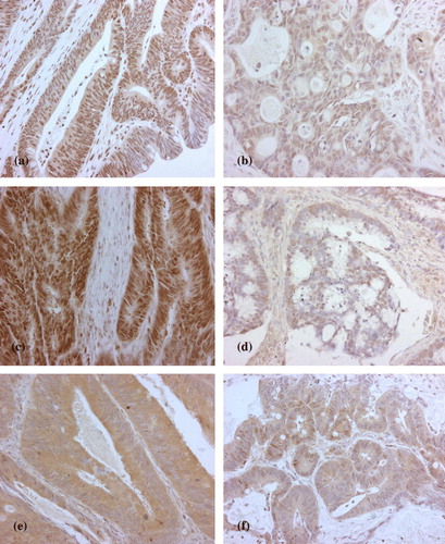 Figure 1.  Examples of high (a), low (b) expression of hMLH1, and high (c), low (d) expression of hMSH2 (c, d). High /Low staining and TS staining (e, f) High/ Low (X20).