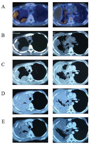 Figure 2. Imaging changes of targeted therapy. The patient developed extensively after radiotherapy and chemotherapy and performed a PET-CT examination (A) on 16 November 2016. Vemurafenib was indicated as a potential benefit drug after NGS. CT scans 2 (B) and 4 (C) months later confirmed its effectiveness. However, CT examination on 19 Jun 2017 (D) found extensive progress in the lung and a second NGS was carried out. Everolimus might be another beneficial drug and the patient took everolimus along with vemurafenib. CT examination on 27 July 2017 (E) suggested lung lesions shrank again.