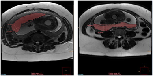 Figure 3. Axial HASTE images through the placentas of two different subjects demonstrating the semiautomated segmentation for calculation of cross-sectional area of placenta on each slice. The placental area on each slice was then summed up and multiplied by the image slice thickness to yield total placental volume. Linear calipers are automatically generated by the software.