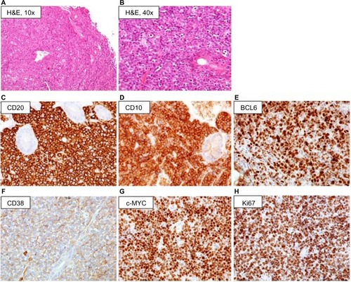 Figure 2 Diagnostic pathology of BL: low magnification (×10, ×40) hematoxylin/eosin staining of BL sample involving the gastrointestinal tract, showing monotonous proliferation of medium-sized basophilic lymphoid cells punctuated by lightly colored macrophages (“starry sky” pattern) (A and B); immunohistochemistry, demonstrating staining for B-cell antigens including CD20 and the early CD10 antigen, with concurrent c-MYC and BCL6 expression and high proliferative rate (Ki67) (C–H).
