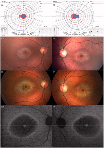 FIGURE 2. Goldmann visual fields of the left (A) and right (B) eyes from the initial visit in 2006, showing ring scotomas consistent with the bull’s eye-appearing macular lesions. Shaded areas indicate the target was not seen in that area. Fundus photos from 2006 (C, right eye and D, left eye) and 2013 (E and F) show some extension of RPE atrophy, apparent at the peripheral boundaries, as well as in the foveal region, in both eyes over 7 years. Near-infrared autofluorescence (G and H) from the 2013 follow-up visit shows hyper-autofluorescence at the fovea, surrounded by hypo-autofluorescence (bull’s eye), further surrounded by a ring of hyper-autofluorescence.