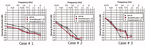 Figure 27. Pure-tone audiometric thresholds determined preoperatively and postoperatively in three patients, implanted with EAS™ [Citation22]. Reproduced by permission of Wolters Kluwer Health, Inc.