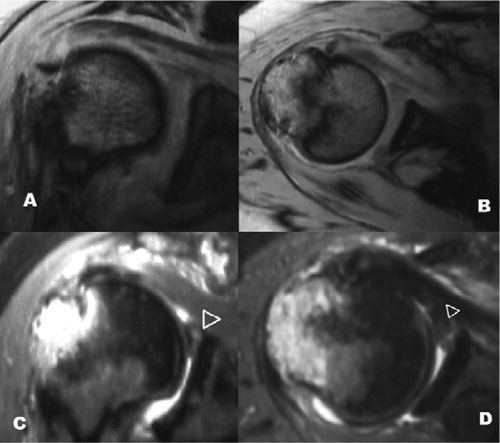 Figure 2. A and B: T1-weighted images; coronal view (A), axial view (B). C and D: T2-weighted images (soft tissue can be seen at tip of arrowhead); coronal view (C), axial view (D).