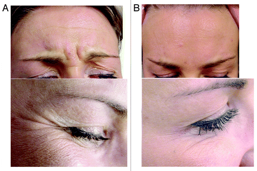 Figure 3. Patient showing glabellar and crow’s feet wrinkles. (A) pre-injection, (B) after injection with botulinum toxin.