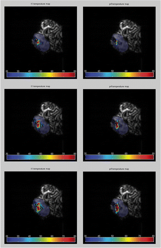 Figure 6. MRTh is calculated from image data during a laser ablation in human cadaveric disc. For imaging the GRE was used (TE = 10ms). Color-coded thermographic plots were mapped over the corresponding MR magnitude images. Calculations based on T1-MRTh (left) and on PRF-MRTh (right) show the heat spread inside the nucleus. The image data were taken at different points during the experiment: (A) after 2 min, (B) after 6min and (C) after 10 min of lasing with a NdYAG laser (1064 nm).