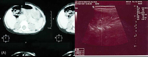 Figure 2. (A) CT image of bilateral renal hypoplasia. (B) Ultrasonographic image showing renal hypoplasia and cysts. Renal size for right kidney was 1.5 cm in length (normal values for neonates 2.5–4.8 cm) and 0.8 cm in depth (normal values for neonates 1.3–2.7 cm).