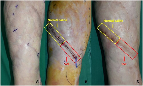 Figure 4. (A) A scar that occurred after trauma to the leg 6 years prior. (B) Immediate postoperative image. The yellow section is the control side and the red section is the experimental treatment side. (C) Six months postoperatively. The scar appears less visible on the experimental treatment side than on the control side.