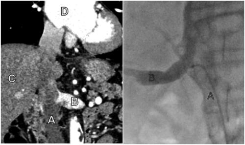 Figure 1. The left picture shows a pre-procedural CT with A – Inferior vena cava, B – Left renal vein, C – Liver, D – Right atrium. The right picture shows fluoroscopy during the procedure with A – Inferior vena cava with sampling catheter, B – Right renal vein with contrast injection to verify the correct sampling location.