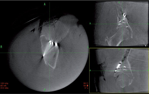 Figure 5. 2D reconstructed images of the 2-column fracture seen in Figure 4 after reduction and indirect screw fixation.