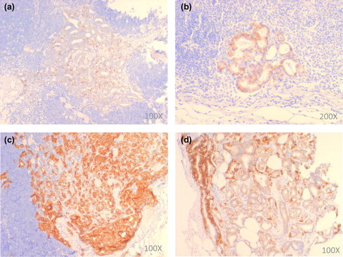 Figure 1. Scoring of immunohistochemical staining for E-cadherin. E-cadherin staining intensity was scored as (a) negative/weak, (b) moderate or (c) strong. The E-cadherin staining pattern was annotated as homogeneous (c) or heterogeneous (d), respectively.