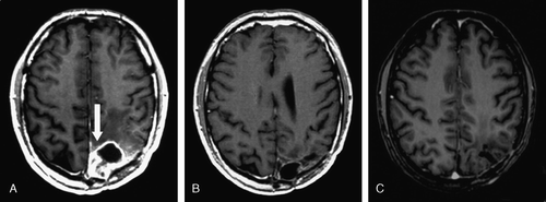 Figure 1.  Imaging of the anti-tumor response of low-dose ultrafractionated radiotherapy. (A) A patient (Table I, #1) with a rapid recurrence of grade II oligodendroglioma (arrow) 4 months after the second operation and 2 weeks before LDUF RT. A complete response is seen (B) 6 months and (C) 2 years later. T1-weighted contrast-enhanced MRIs.