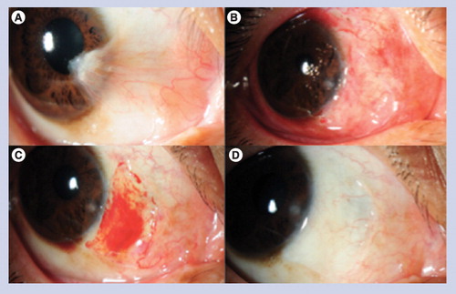 Figure 2. Pterygium excision with conjunctival autograft attached with fibrin glue.(A) Before operation; (B) 1 day after operation; (C) 1 week after operation; (D) 3 months after operation.