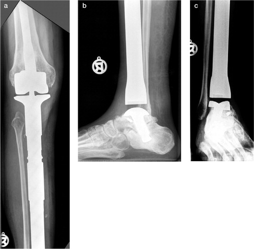 Figure 4. 2 years after surgery:osteointegration of the femoral component (a) and talar component (b). The talar component was implanted taking the trans-calcanear angle into account (c).