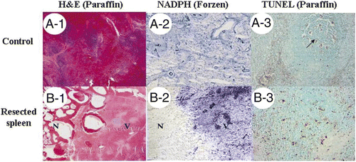 Figure 4. Histological examination of surgical margins. (A) Control splenic tissue (A1) was positive for NADPH-diaphorase activity (A2) and showed apoptosis only within the white pulp under TUNEL assay (A3). (B) Immediately resected spleen (B1) showed loss of NADPH (B2) in necrotic area (N) compared to viable splenic tissue (V). Increase of apoptosis in necrotic area was also noted (B3). (A1, A2, B-1, and B2: magnified 10×; A3 and B3: 100×).