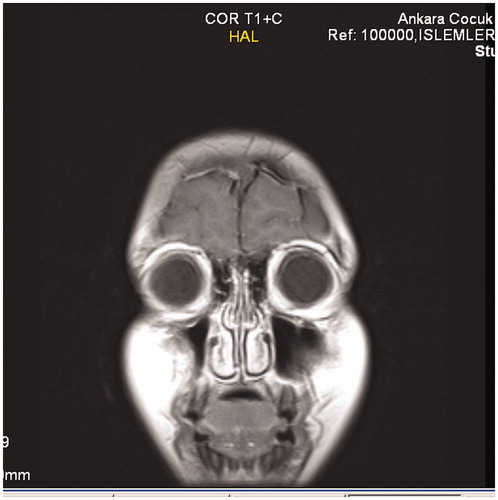 FIGURE 3. Cranial MRI-T1 coronal section with contrast injection.