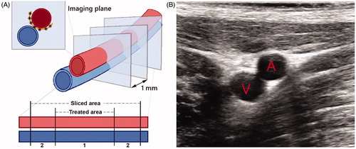 Figure 2. (A) Schematic image of the EFA (red) and vein (blue) and the transversal imaging planes as imaged and treated during the procedure. 6–8 HIFU shots were delivered in between the artery and the vein (black asterisks) which form a continuous lesion (orange semicircle). The lower part of the scheme represents the simplified cutting process, differentiating between the target area and the sliced area. Area A contains the target area of 2.5–3.5 cm, while area B is outside the treatment range, which explains that we identified slides without histological changes. (B) (Diagnostic) ultrasound image of the transversal plane of the EFA (A) and femoral vein (V). The image view is the same as during the procedure while using the HIFU/DMUA imaging.