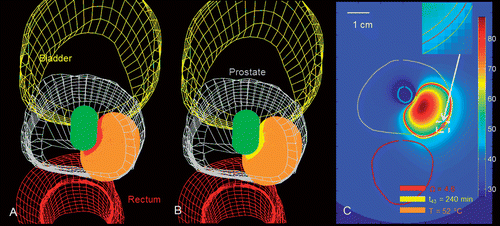 Figure 9. Patient-specific treatment simulation and plan for targeting focal prostate cancer in the posterior gland using a directional (90°) transurethral ultrasound applicator directing energy toward the periphery. (A) Thermal damage (Ω ≥ 4.6) and temperature (T ≥ 52°C) isosurfaces indicating coagulative necrosis. (B) Thermal dose (t43 ≥ 240 min) and temperature (T ≥ 52°C) isosurfaces indicating coagulative necrosis. (C) Temperature map in axial slice through the centre of the applicator with critical temperature, thermal dose, and thermal damage contours overlaid.