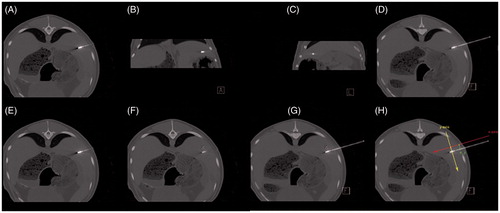 Figure 5. Feasibility of CT-guided thermal ablation by using 3D image post-processing with definition of the master image slice. (A–C, E, F) Standard image planes (transversal, coronal and sagittal). (D, G, H) Master image slice. Positioning of the applicator using standard image planes (A–C). In the standard image planes, the entire course of the applicator shaft (A, E), as well as a fictive tumour centre (white X) (F) did not appear in one single image slice. After individual image angulation the entire course of the applicator shaft as well as the fictive tumour centre (white X) became obvious in one single image slice (master image slice) (D, G, H) with x-axis and y-axis as defined in the Cartesian coordinate system. The direction of the x-axis (red) defined the direction of the applicator shaft; the y-axis (yellow) was defined as being perpendicular to the applicator shaft. In the master image slice, the distance between the applicator shaft and the tumour centre (white X) defines ey (green) (H).
