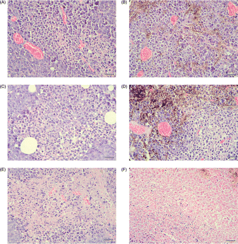 Figure 2. The tumor tissues stained by hematoxylin-eosin (HE). (A) 1 h after injecting with physiological saline; (B) 1 h after injecting with magnetic fluid; (C) 1 h after injecting with physiological saline and exposed to magnetic field; (D) 1 h after injecting with magnetic fluid and exposed to magnetic field; (E) 48 h after injecting with physiological saline and exposed to magnetic field; (F) 48 h after injecting with magnetic fluid and exposed to magnetic field. (The black points in B, D and F were the magnetic fluid. The scale bars represent 50 µm. A little necrosis was shown near magnetic fluid in D. Compared with A, B, C, D and E, more nucleus disaggregation and cell broken were shown around magnetic fluid in F. The necrosis in E is near the center of the tissue, however, the necrosis in f is distributed around magnetic fluid.)
