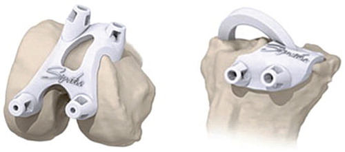 Figure 1. SPPC alignment guides for femur and tibia.