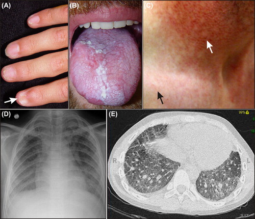 Figure 2. Phenotypic features of dyskeratosis congenita (DC). (A) Nail dystrophy (arrow) in an adolescent. (B) Oral leukoplakia in an adult. (C) Skin changes in an adult. Hypopigmented lesions and the typical reticular rash of DC are evident on the upper chest (black arrow). Hypopigmentation is more pronounced in the sun-damaged skin of the neck (white arrow). (D) and (E) Pulmonary fibrosis on chest radiograph and CT scan of an adult. Photographs courtesy of Susan J. Bayliss, MD, and William H. McAlister, MD.