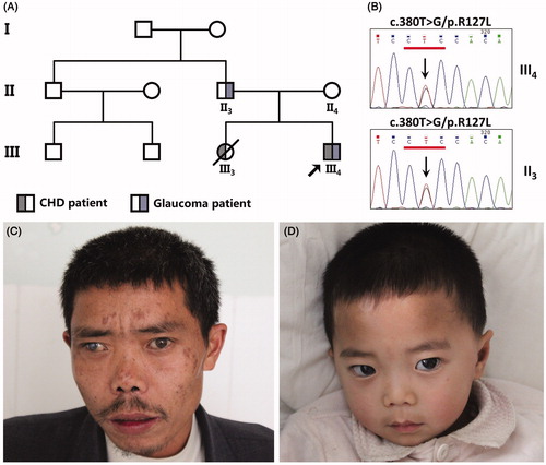 FIGURE 1. Clinical features of the family affected with ARS. (A) Symbols for affected individuals are colored in. The proband (III4) has congenital glaucoma and accompanying congenital heart disease due to PDA. His father (II3) only has glaucoma. His sister (III3) who died in 2010 due to dilated cardiomyopathy, heart failure, cardiogenic shock and accompanying pulmonary edema. (B) Sequence chromatogram indicates a G to T transition of nucleotide 127 in the proband (III4) and his father (II3). (C) The proband’s father has a congenital detachment of the retina as well as glaucoma. (D) The proband also suffers from glaucoma but neither of them have other facial anomalies.