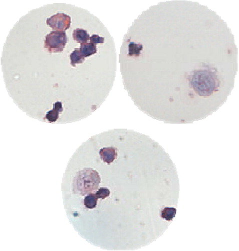 Figure 5. CTCs captured in the peripheral blood of lung cancer patients through the novel immunomagnetic separation method, and white cells around the CTCs, in the slide observed under the 40 × light microscope.