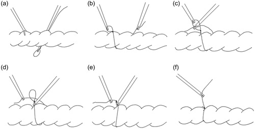 Figure 2. Conventional method for laparoscopically ligating an organ.