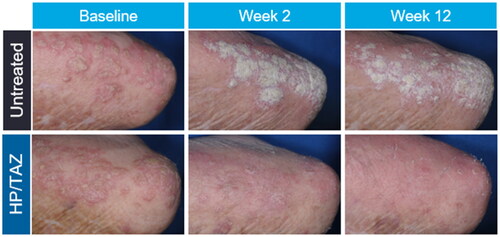 Figure 2. Psoriatic plaques treated with HP/TAZ improved from baseline to week 12 compared to untreated plaques. Patient consent was obtained for the use of all photographs. HP/TAZ, halobetasol propionate 0.01% and tazarotene 0.045%.
