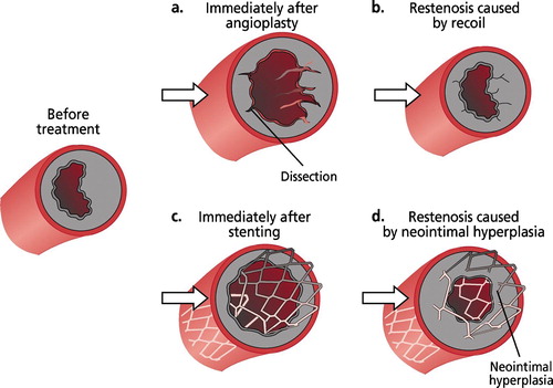 Figure 1. Restenosis of a coronary artery after balloon angioplasty(a–b) and after stenting (c–d).