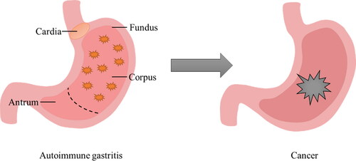 Figure 1. Inflammatory location and deterioration of AIG. The stomach is mainly divided into four parts, namely the cardia, fundus, corpus, and antrum glands. The area of inflammation of AIG is concentrated in the fundus and corpus glands of the stomach. Allowing the development of AIG disease will eventually lead to cancer.