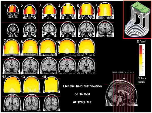 Figure 5. Colored field maps for the H4-coil indicating the absolute magnitude electrical field in each pixel at 120% of hand motor threshold, for 14 coronal slices 1 cm apart. Red pixels indicate regions with field intensity above the threshold for neuronal activation. Full color available online.