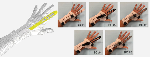 Figure 1. Dynamic wrist–hand–finger orthosis. Rendering of prototype orthosis on the left and fabrications of orthosis on the right with five different finger-extension components fabricated using 3DP elastic materials from commercial vendors: (i) thermoplastic polyurethane by Shapeways Holdings, Inc.; (ii) elastomeric polyurethane by Shapeways Holdings, inc.; (iii) thermoplastic polyurethane by Sculpteo; (iv) elastomeric polyurethane by Sculpteo; and (v) thermoplastic polyurethane by i.Materialize N.V.