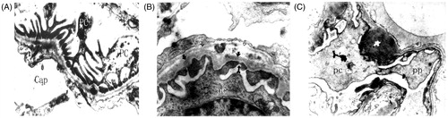 Figure 6. Ultrastructure analysis of podocytes. Notes: Electron microscopy×10,000 Podocyte foot processes were already effaced in some glomeruli in SHR rats. (A) WKY 24W, (B) SHR 12W, (C) SHR 24W.