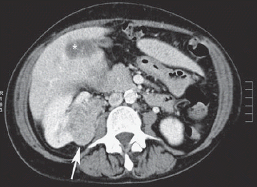 Figure 1. CT-scan of the abdomen, performed one month after surgical resection of the primary tumor, shows liver metastases (asterisk) and an incidentally found angiomyolipoma (white arrow) in the right kidney.