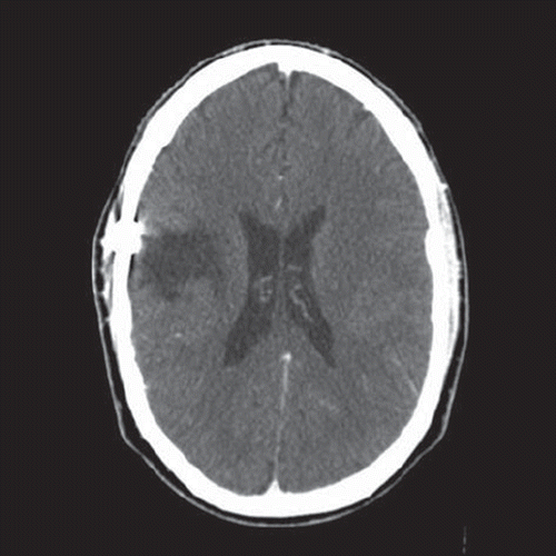 Figure 5. Five weeks postoperatively, CT-scan performed after i.v. contrast injection, showing no signs of remaining tumour and the haematoma is totally absorbed.
