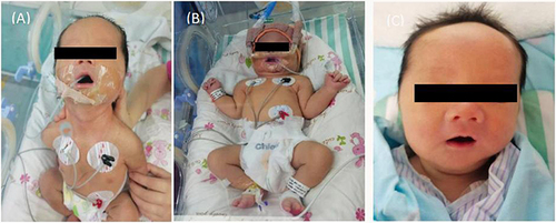 Figure 1 (A) Generalized hypotonia with marked poor head erect and suck ability. (B) Need auxiliary ventilation for muscular disorders especially respiratory muscle weakness. (C) Discharged home on day 26 without respiratory and gastric tube support.