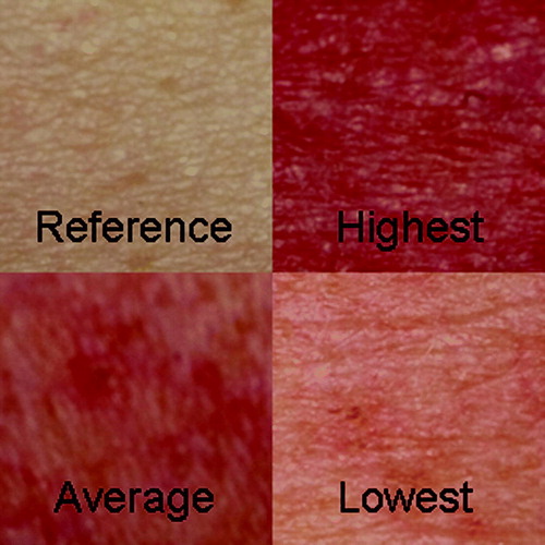 Figure 3.  The developed erythema in dose interval 46–50 Gy for the lowest, highest and median individual compared to a reference photograph
