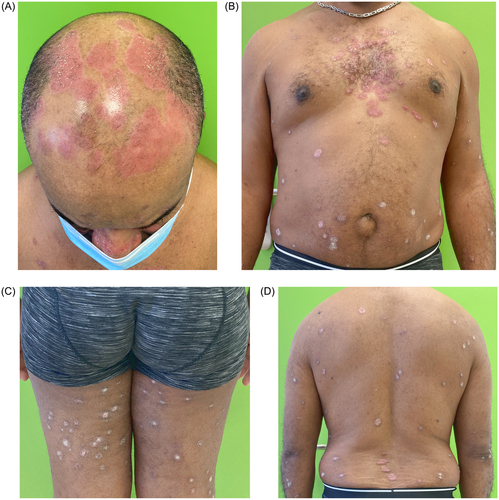 Figure 1. (A–D) Clinical presentation of the cutaneous lesions before initiating oral roflumilast. Scalp is especially affected, associated with moderate pruritus (consent from the patient was obtained).