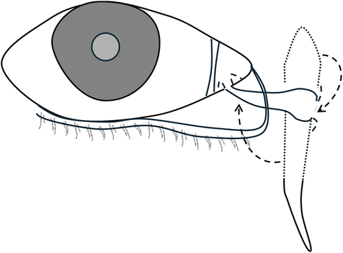 Figure 5. Conjunctivoductivodacryocystorhinostomy.