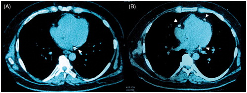 Figure 3. (A) Baseline MSCT and (B) Follow-up MSCT of a HD patient. There is a significant increase of coronary artery calcifications (arrowheads). MSCT: multislice computed tomography, HD: hemodialysis, CS: calcium score.