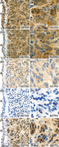 Figure 2. Expression of somatostatin receptor protein in GIST. SSTR1, 2, 3, and 5 proteins localized to tumor cell cytoplasm. SSTR4 protein was undetectable. Immunoperoxidase staining of consecutive sections from tumor biopsy from patient no. 12 (small intestinal, low-risk, wt in KIT and PDGFRA). Brown = antibody labeling. Blue = nuclear counter staining. Left panel (A, C, E, G, I): low power (bar equals 50 μm). Right panel (B, D, F, H, J): high power (bar equals 20 μm). *indicates luminal side of vascular profile.