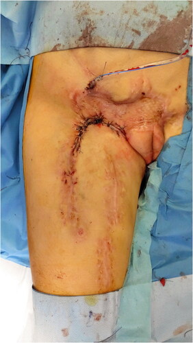 Figure 7. Appearance of the thigh after removal of thrombosed portion of the femoral artery and femoral vein and the new advancement thigh flap.