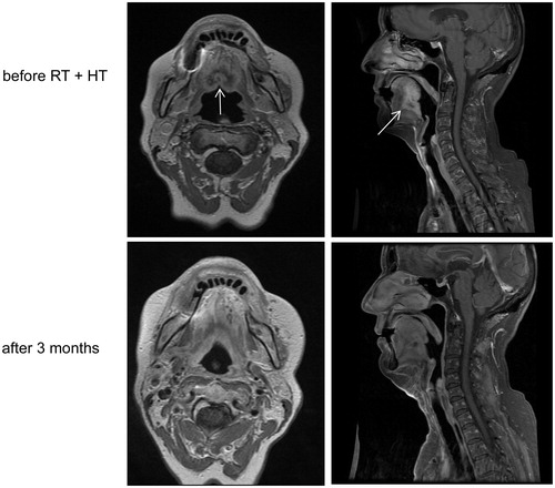 Figure 3. Example of complete response after combined hyperthermia and irradiation in a cT4N0M0 carcinoma of the base of tongue.