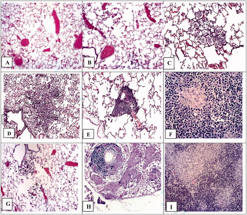 Figure 4. Lung and lymph node tissues 13 weeks after intratracheal instillation with unground lunar dust (LD-ug) and reference dusts (TiO2, and quartz). (A) Control rat: normal lung structure; (B) LD-ug, low dose: some particles in macrophages, no lesions; (C) LD-ug, mid dose: a gathering of dust particles, macrophages, and inflammatory cells in alveoli, some alveolar walls were thicker than those of more normal adjacent alveoli; (D) LD-ug, high dose (hd): a low-grade granuloma (microscopic nodule) consisting of PLMs, inflammatory cells, and thickened alveolar septa. (E) LD-ug, hd: an accumulation predominately composed of lymphocytes and particle-laden macrophages with some neutrophils visible around a blood vessel, characterized as vasculitis; (F) LD-ug, hd: low-grade granulomas (pink areas) containing fine LD grains mostly inside macrophages among lymphoid cells (in blue) in a mediastinal lymph node with no/minimal fibrosis, (G) TiO2, hd: showed TiO2 particles, minimal or no lesions; (H) Quartz, hd: Many large granulomas with moderate fibrosis, severe vasculitis; (I) Quartz, hd: A large structureless granuloma with diffuse and moderate fibrosis in a mediastinal lymph node (Magnifications: 10× to 50×.).